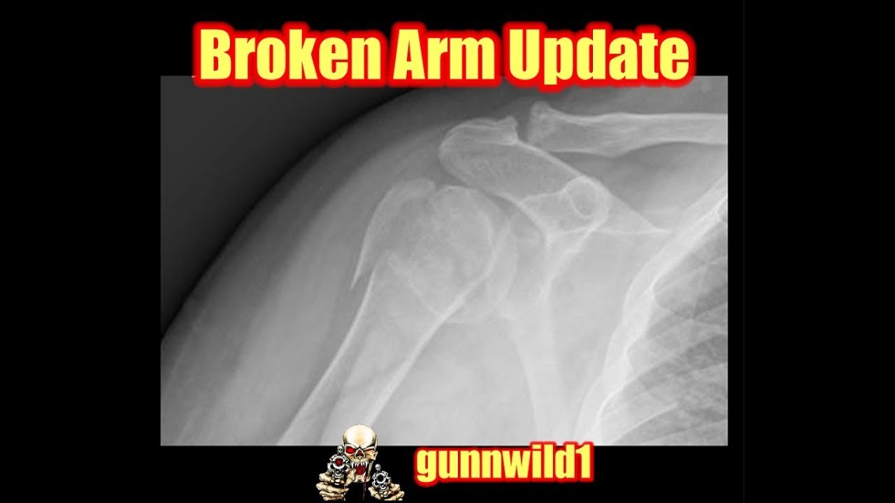 Broken arm update
